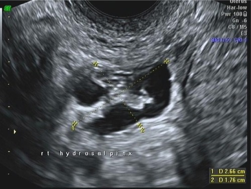Figure 5 Transvaginal ultrasound in a 28-year-old nulligravida.