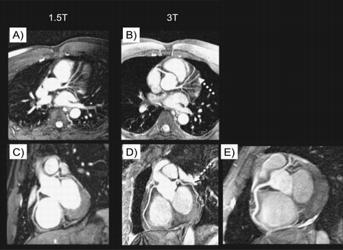 Figure 1. Left and right coronary arterial system obtained at 1.5 T (A, C) and 3 T (B, D) in the same subjects. Note the improved visual vessel delineation with more anatomical detail information (dashed arrows) obtained at the higher field‐strength. In E, an example right coronary system obtained at 3 T is displayed.