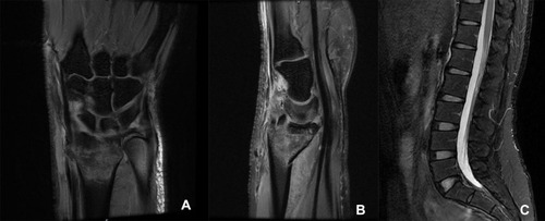 Figure 1 MRI T2 images (A and B) of the right wrist showed Barton fracture with marrow edema. MRI T2 images (C) showed no fractures in lumbar vertebrae.