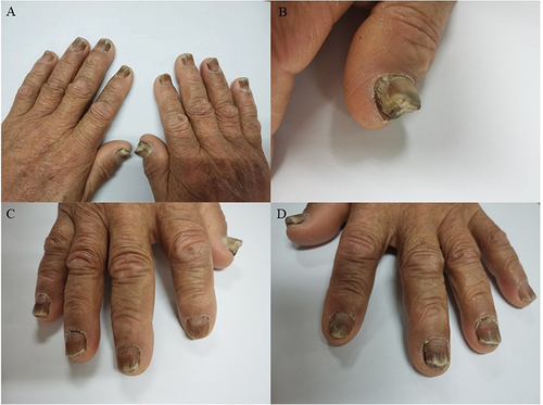 Figure 1 Changes in the nails of patients after treatment with durvalumab at the same time and at different angles. (A) The ten fingers of both hands. (B) The right thumb. (C) The five fingers of the right hand. (D) The five fingers of the left hand.