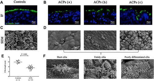 Figure 5 The comparison of cilia expression patterns by IF staining and SEM images in the same samples. (A and B) The expression patterns of a-tubulin by IF in controls and ACPs. (C and D) The cilia expression patterns of SEM in the same control (n = 3) and ACPs (n = 3) samples. (x10,000 magnification). (E) Comparison of the cilia length in patients with ACPs (n = 13) and control subjects (n = 6) in paraffin-embedded sections. (F) Cilia expression pattern of SEM shows short, untidy cilia and poorly differentiated cilia in ACPs. Mann–Whitney 2-tailed U-test; median values with 25th and 75th percentiles are indicated by horizontal lines. P < 0.05 was statistically significant.