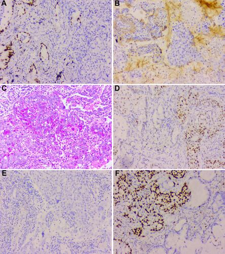 Figure 6 The immunohistochemistry results of hepatoid adenocarcinoma. The hepatoid adenocarcinoma of the lung of our patient is positive for TTF1 (A), SP-B (B), PAS (C), and P53 (D) and negative for AFP (E). (F) The proliferation index by Ki-67 staining is above 70%.