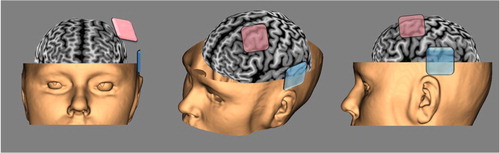 Fig. 2 Typical tDCS montage for research and treatment of Schizophrenia (anode in pink over the left DLPFC, cathode in blue over the left temporo-parietal junction).