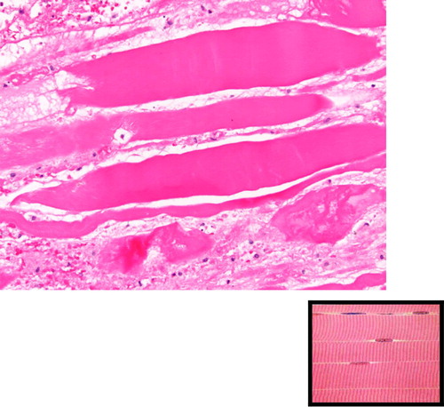 Fig. 5 Longitudinal sections showing loss of striation, in comparison to the normal appearance shown in the bottom right corner.