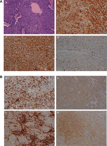 Figure 2 Histopathology of the pancreas tumor.