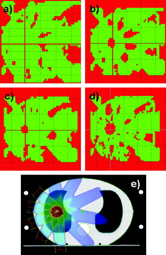 Figure 4.  Five field SBRT treatment plan. The slice in the isocentre was selected. a) 2D dose distribution calculated with AAA at 6 MV. b) Calculated with PBC at 6 MV. In the isocentre the dose is up to 17% too high. c) Calculated with AAA at 15 MV. In the isocentre the dose is 9% too high. d) Calculated with PBC at 15 MV. In the isocentre the dose is 32% too high. e) The field configuration and the dose colour wash are shown for 6 MV. The dose colour wash is displayed in percents.The red colour is an indication of the areas where the gamma criteria of 3% in dose and 3 mm in DTA were not fulfilled. The green areas represent the regions where the criteria were fulfilled.