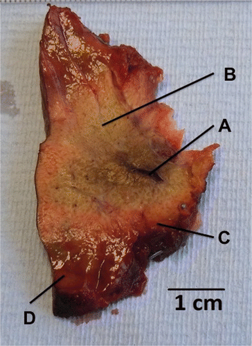 Figure 3. Macroscopic appearance of ablated parenchyma. After 30 s at 50 W, a mean ablation diameter of 21.3 mm ± 1 was achieved. Note the antenna track with some evidence of charring (A), white zone, consisting of blanched parenchyma within the ablation zone (B), red zone, the rim of haemorrhagic tissue (C) and the surrounding normal-looking parenchyma (D).