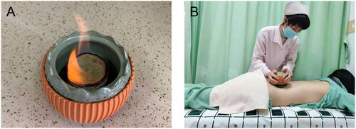 Figure 1. Fire Dragon Jar. (A) Picture of Fire Dragon Jar. (B) The nurse does Fire Dragon Jar to the patient.