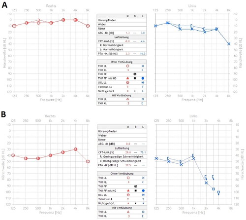 Figure 1. A + B: pure tone audiogram of right (red) and left (blue) ear, air and bone conduction. A: audiogram at initial consultation: hearing thresholds within normal limits, slight decrease in mid and high frequencies on the left side compared to the right side. B: follow-up audiogram after 4 weeks: bilateral asymmetric sensorineural hearing loss.