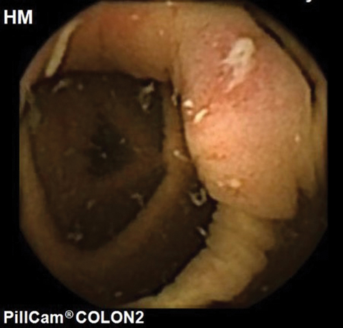 Figure 6. Colon capsule image of ileocecal valve with ulceration.
