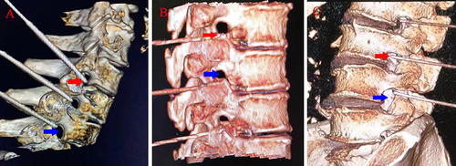 Figure 5 CT guided neck (A), chest (B) and lumbar (C) puncture (three-dimensional imaging shows that the needle tip is located outside the intervertebral foramen).