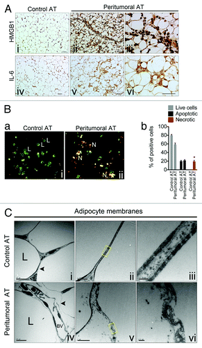 Figure 2. Peritumoral adipose tissue atrophy is accompanied by infiltration of HMGB1+ inflammatory cells and adipocyte necrosis. Immunohistochemical analysis for marker of necrosis, HMGB1 revealed intensive cytoplasmic staining of adipocytes from peritumoral AT as well as the presence of HMGB1+ inflammatory cells, size bar = 50 μm (A, i and ii) and size bar = 25 μm (iii). The HMGB1 expression pattern matched that of IL-6, size bar = 50 μm (iv and v) and size bar = 25 μm (vi). Morphology of adipocytes isolated from control and peritumoral AT and then stained using Ethidium Bromide/Acridine Orange. Live cells (L) stain green and are round with two or fewer yellow dots; apoptotic cells with intact plasma membranes stain green, are irregularly shaped, often due to membrane blebbing, and contain multiple yellow/green dots of condensed nuclei. Cells undergoing necrosis (N) stain bright orange due to the influx of ethidium bromide and contain multiple yellow/green/orange condensed nuclei (B, a). Quantification of live, apoptotic and necrotic cells (b). Electron micrograph examining adipocyte membranes in control and peritumoral AT (C, i–vi). Note the ruptured basal membrane and presence of cellular debris in peritumoral AT. The boxed yellow areas are magnified in (iii) and (vi). “L” marks the lipid droplet and “BV” marks a blood vessel. Data presented are mean values ± SEM *P < 0.05; **P < 0.01; and ***P < 0.001, the Student t test.