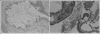 Figure 1 Lung histology obtained from a patient who had died during a COPD exacerbation [pictures from Ref. Citation[44]]. Left: The lumen of a terminal bronchiole showing mucus admixed with scattered inflammatory cells and desquamated epithelial cells. Focally, the mucosal layer shows basal cell hyperplasia and (arrow) mucosal lining by mucin-producing cells (hematoxylin-eosin, original × 400). Right: A respiratory bronchiole with luminal accumulation of mucus admixed with desquamated cells and inflammatory cells. The alveolar septa show vascular congestion and increased numbers of acute inflammatory cells (arrows) (pentachrome, original × 400).