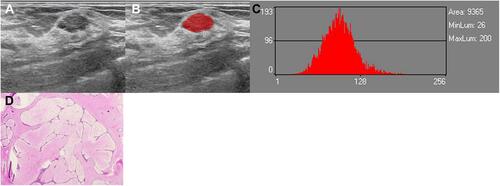 Figure 3 A 47-year-old woman with FA in the right breast. (A and B) An ROI for the oval hypoechoic mass in the grey-scale US image. (C) Grey-scale histogram of the tumor. The values of grey-scale histogram parameters are as follows: mean, 96.701; variance, 580.27; skewness, 0.40754; and kurtosis, 0.59665; 1st percentile, 46; 10th percentile, 67; 50th percentile, 96; 90th percentile, 126; and 99th percentile, 164. (D) Microscopically, spindle cells in the stroma are nodular hyperplasia with mucus degeneration, and the compressed duct is fissure (HE×100).