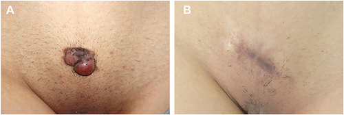 Figure 4 Example of keloid in pubic region treated with excision followed by intralesional 5-FU and betamethasone. (A) Before treatment, (B) at 6 months of follow-up.