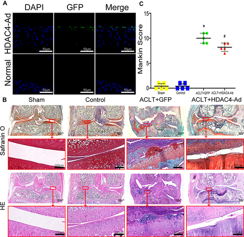 Figure 5 Osteoarthritis (OA) progression decelerated after the intra-articular injection of histone deacetylase 4 (HDAC4) in rats. (A) Fluorescence microscopy images of HDAC4-green fluorescent protein (GFP) chondrocytes with DAPI staining. Scale bars:50μm. (B) HE and SafO staining of rat knee joints at three months after the procedure. Mice in the Control group receive no intervention. Typical OA was observed in the ACLT+GFP group. Milder OA was observed in the ACLT+HDAC4-Ad group. Scale bars for Up panel images were 500μm. And Scale bars for down panel images were 100μm. (C) Mankin scores were analyzed to quantify the degree of OA. With the intra-articular injection of HDAC4, the progression of OA was decelerated. *P < 0.05, ACLT+GFP vs Control; #P < 0.05, ACLT+HDAC4-Ad vs ACLT+GFP; n = 5 pre group.