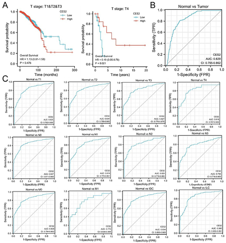 Figure 3 Kaplan–Meier survival curves and ROC analysis curves of CES2 patients. (A) Correlation between CES2 expression and prognosis in breast cancer stages T1, T2, T3, and T4. (B and C) Diagnostic value of ROC analysis of CES2 in all stages of TNM, invasive ductal carcinoma, and invasive lobular carcinoma.