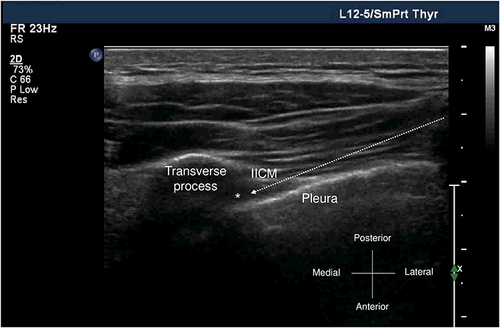 Figure 2 Ultrasound image of thoracic paravertebral space. The asterisk represents paravertebral space (PVS). The arrow represents needle direction.