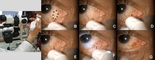 Figure 1 Steps of the PANIS method to remove the conjunctival cyst. (A) Place the patient behind the slit lamp and use the white handpiece of Plexr device (B) The cyst of patient No. 5 (C) Apply the first spot to drain the fluid of the cyst (D) Apply consecutive spots at the edge of the cyst (E) Continue the spots and reach the initial spot (F) Apply some spots to the base of the cyst to prevent recurrence and around the cyst to fuse conjunctival tissue to the underlying layers (G) End of the surgery and complete removal of the cyst.