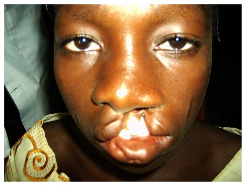 Figure 1 A 14-year-old girl with a complete unilateral cleft of the lip and alveolus.