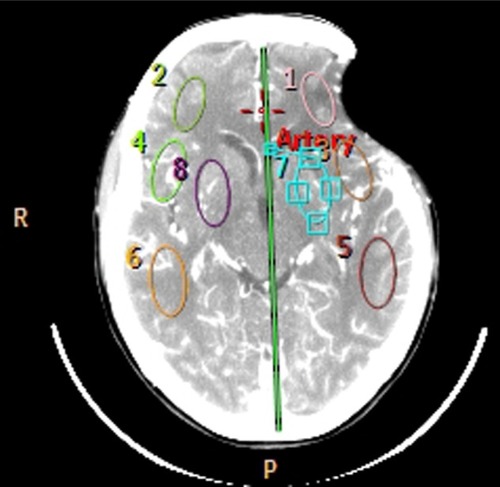 Figure 1 Computed tomography perfusion with four regions of interest selected in each cerebral hemisphere.