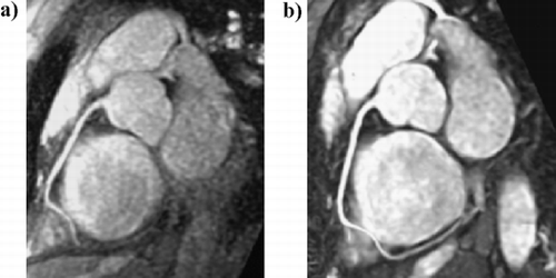 Figure 1. RCA images (MIP) of the same volunteer acquired with a 4‐channel (left) and a 32 channel (right) phased array. The distal portion of the RCA is clearly visualized in the 32‐channel image due to a 40% SNR improvement over the 4‐channel image.