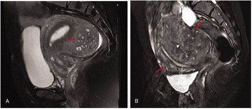 Figure 2. External adenomyosis: the ill-demarcated equal intensity area indicate adenomyosis (red arrow heads) which was located in the outer myometrium of the uterine wall, the healthy muscular structures were preserved in between the adenomyotic lesion and the junctional zone, and the junctional zone was kept intact without aberrancy. A. asymetric external adenomyosis; B. symmetric extenal adenomyosis.