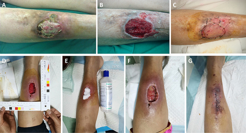 Figure 2 Presentation Pictures of typical cases of experimental group.One patient developed an infectious wound with MRSA on the right leg (A-C). (A), wound infection with MRSA before debridement. (B) After treated with Prontosan®-soaked gauze 8 days, the wound infection has been cleared and the granulation was growing well. (C) wound was covered by skin graft. Other patient was suffered by wound infection with MRSA and soft tissue necrosis (D-G). (D and E) wound infection with MRSA and treated with Prontosan®-soaked gauze. (F) 3 days after treated by Prontosan, wound infection improved significantly. (G) wound was sutured after treated by Prontosan 9 day.