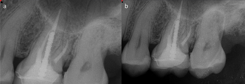 Figure 1. (a) Periapical radiograph shows that tooth #14 is root canal treated, well-filled, restored with a post and core-build up, with a provisional crown in place. There is no widening of the periodontal ligament space or other periapical or bony pathology. (b) Bitewing radiograph shows likely open margin of provisional crown on distal aspect.