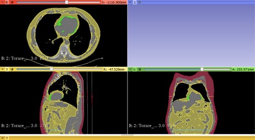 Figure 1 Epicardiac fat volume (green), total visceral fat volume (yellow – second view), L4 vertebral visceral fat volume (blue line) and subcutaneous adipose tissue volume (red) measured with 3D Slicer software.