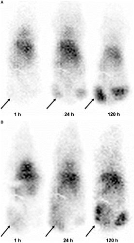 Figure 1. Images of A431 tumor-bearing nude mice receiving intravenous 111In-MX-B3. Tumors were exposed to pulsed-HIFU with 2 exposure parameters: TAP of 20 W (A) and TAP of 40 W (B); pulse repetition frequency, 1 Hz; duty cycle, 5% (50 ms on and 950 ms off). One hundred pulses were given at each raster point. Within 10 min, mice were injected intravenously with 11 MBq (32 µg) of 111In-MX-B3. Static imaging was acquired for 40,000 counts at 1, 24, and 120 h after injection and immediate anesthetization with ketamine (60 mg/kg)/xylazine (10 mg/kg). Pulsed HIFU–exposed tumors are indicated by arrows while the contralateral, untreated tumors were used as controls. Animals pulsed at 40 W had earlier and higher uptake than those treated at 20 W. The difference between 40 W treated and untreated tumors was not measurable by 120 h. (Citation[56] Reprinted with permission.)