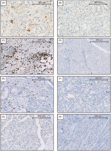 Figure 1. Intratumoral PD-L1 expression and immune cell infiltration. Representatives of the immunohistochemical stainings. (A) PDL1 expression >1%. (B) PD-L1 expression <1%. (C) CD8 > 80 cells/mm2. (D) CD8 < 80 cells/mm2. (E) CD66b >60 cells/mm2. (F) CD66b <60 cells/mm2. (G) CD57 > 10 cells/mm2. (H) CD57 < 10 cells/mm2.