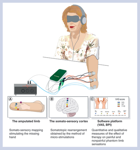 Figure 4. Study end points for a natural sensory feedback by transcutaneous electrical stimulations in amputee patients.One part of the European EPIONE project is based on a noninvasive approach of transcutaneous electrical stimulations in order to create nonpainful sensations to the amputated patient suffering from phantom limb pain (A) and therefore alleviate the pain intensity by restoring neuroplastic changes in the cortex (B). A software platform was developed in order to quantitatively and qualitatively follow the effect of the therapy on the painful and nonpainful phantom limb sensations, as well as the psychological state of the patients through multiple questionnaires (C).VAS: Visual analog scale.