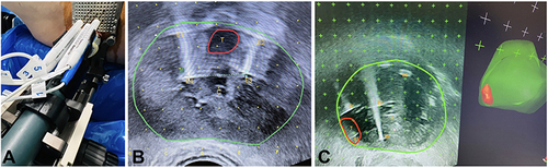 Figure 1 IRE (Nano-Knife) treatment. (A) (Left): Electrodes inserted via transperineal grid, parallel to ultrasound probe. (B) (Middle): Primary IRE case, ultrasound transverse view, green – contour of prostate, red – anterior lesion. T=Tumour, E=Electrode (1–4), C=Catheter. Tumour is surrounded with safety margins. (C) (Right): IRE salvage case (brachytherapy+HBRT failure): on right the lesion (red) and prostate (green) in 3D view (Bio-Jet, Fusion system, BK ultrasound). Transverse view, T=Tumour, E=Electrode (1–4), BS=Brachytherapy seeds. The lesion is on right posterolateral mid prostate. The electrodes encircle the lesion+safety margins. All images in this text are original, copyrighted to authors, anonymous and used under the consent of patients.