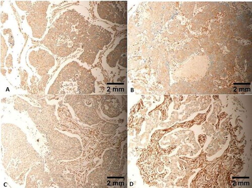 Figure 6. Mild cytoplasmic expression of FLNA in all tumour cells, IRS of 6/12. Tumours (A and C) are both grade 3. Tumours (B and D) are both grade 2. Tumours (A–C) are all stage II. Tumour D is stage I. Tumours (A–C) are all T2N0M0. Tumour D is T1N0M0. Scale bar = 2 mm for panels A–D.