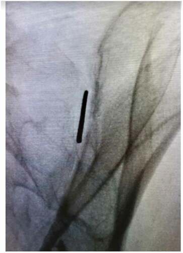 Figure 1. Optimal placement of guide pin in the contralateral oblique view.