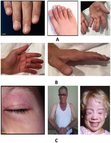 Figure 2 (A) The red-white and bluish discoloration in images 1 and 2, the monophasic discoloration in image 3; (B) the swelling around proximal and distal phalanges. Also, the prominent “knobby” fingers; (C) heliotrope rash over eyelids with periorbital oedema in image 1 and heliotrope rash on face and facial erythema in image 2. Notice the purplish coloration. Copyright (2022) ACR.