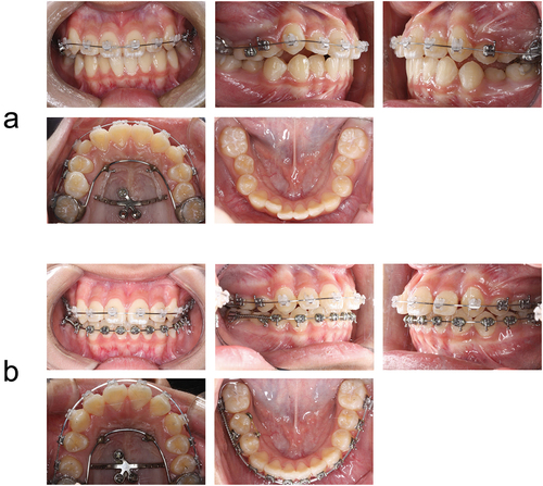 Figure 5. Treatment Progress: after insertion of MCPP and PRA appliance (a), 10 months into treatment (b).