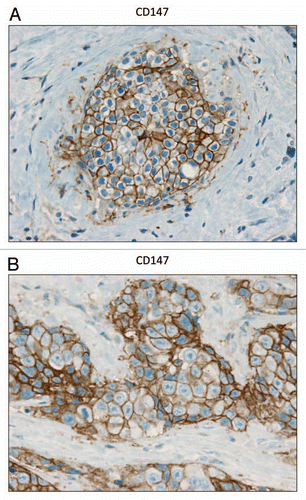 Figure 7 CD147 is expressed in the epithelial compartment of human breast cancers. Note that epithelial cancer cells express CD147 in human breast tumor samples. Two representative images are shown. Both clearly show that CD147 staining is present in the tumor epithelial cells, but is largely absent in the surrounding stroma. Panel (A) shows DCIS-like lesions and the surrounding CD147(+) epithelial cancer cells. Panel (B) shows that CD147 staining identifies the epithelial cancer cells within the “cancer cell nests.” The original magnifications for both (A and B) are 60×.
