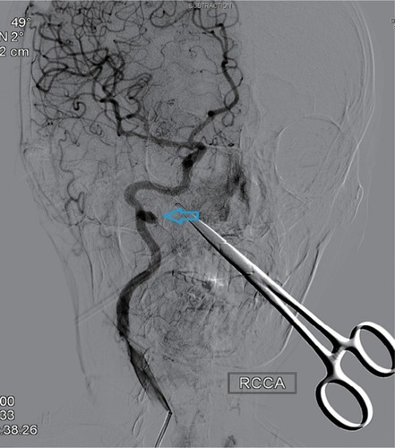 Figure 5 Right lateral internal carotid artery angiogram showing radiation arteritis with pseudoaneurysm (indicated by the arrow).Note: RCCA=right common carotid artery.