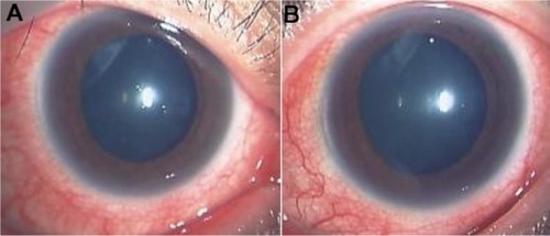 Figure 2 Slit-lamp examinations of the right eye (A) and left eye (B) in 2012. slit-lamp biomicroscopy revealed strong conjunctivitis and episcleritis in both eyes treated with mydriatics.