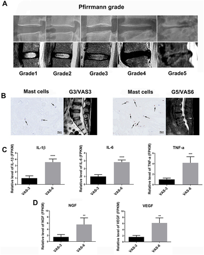 Figure 4 Mast cell activation and inflammation were significantly higher in NP tissues in IVDD patients with severe pain. (A) The appearance of different degrees of disc degeneration (Pfirrmann grade) on radiographs and lumbar MRI images. (B) The number of mast cells in the NP of patients in VAS 3 and VAS 6- NP tissues and MRI images of lumbar vertebrae. (C) Expression of inflammation- and pain-related factors in VAS 3 and VAS 6- NP tissues. ***P < 0.001, ****P < 0.0001. (D) The expression of nerve and vascular growth factors in in VAS 3 and VAS 6- NP tissues.**P < 0.01.