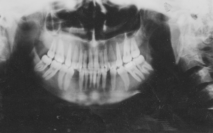 Figure 1. Expansive cyst-like lesion on the left ramus mandibulae.