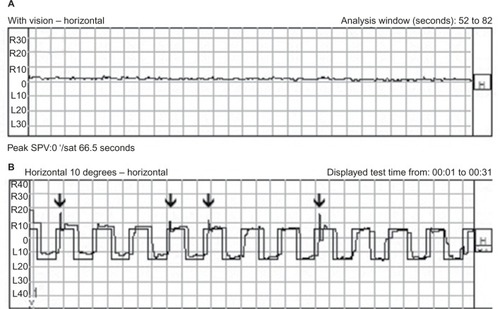 Figure 1 (A) Videonystagmogram shows no horizontal nystagmus component. (B) Horizontal saccades show hypermetric saccades to the right (arrows).