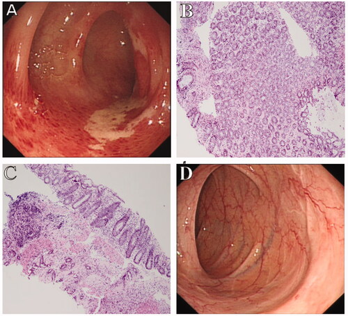 Figure 3. Colonoscopic and pathological findings of a 63-year-old female patient with mild CI. (A) Colonoscopy shows typical longitudinal ulceration (colon single stripe sign), exudate, and congestive edema at the sigmoid colon. (B,C) Biopsy shows epithelial abscission, atrophic glands, and inflammatory cell infiltration in the lamina propria (original magnification: ×200). (D) One-month follow-up of routine colonoscopy shows complete mucosal healing with white scar.