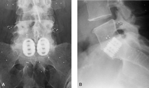 Figure 8:1 Patient number 1. Conventional radiography showing no reaction around the implant at one year follow-up. Tantalum indicators both in the ventral and dorsal parts of the vertebrae fused. A. Anteroposterior view. B. Lateral view.