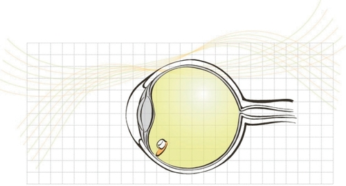 Figure 1 The fluocinolone acetonide device is inserted into the vitreous cavity through a scleral incision and anchored with a suture.