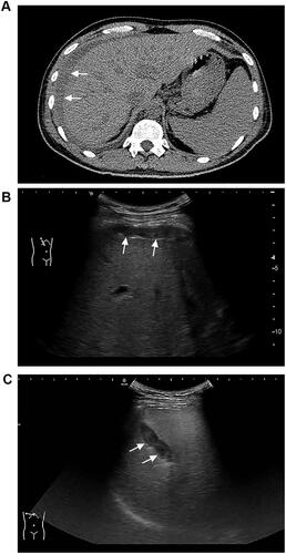Figure 2 (A) Computed tomography image obtained 6 hours after PBL showing a hemoperitoneum in a 40-year-old man (The perihepatic hemorrhage is designated by the arrow). (B) Ultrasound image obtained 18 hours after PBL showing perihepatic free abdominal fluid in a 61-year-old woman (The perihepatic free abdominal fluid is designated by the arrow). (C) Ultrasound image obtained 12 hours after PBL showing an intrahepatic hematoma in a 56-year-old man (The intrahepatic hematoma is designated by the arrow).