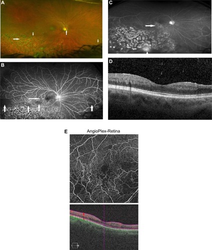 Figure 2 Hemiretinal vein occlusion, right eye.