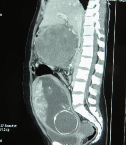 Figure 2 CT sagittal image shows heterogeneously enhancing pancreatic mass along with a fetus within the uterus.